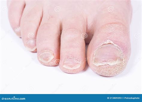 Damaged Toenails Onychomycosis Nail Psoriasis Stock Image Image Of