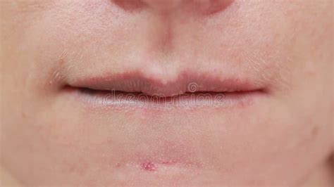Female Lips With Bruise Close Up Effects Of Hyaluronic Acid Lip