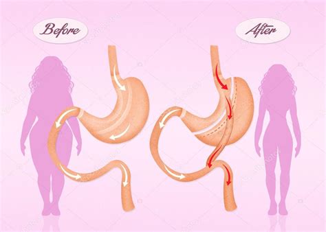 Antes e depois da cirurgia de bypass gástrico — Stock Photo