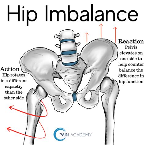 Hip Imbalance Pain Academy