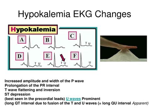 Ppt Hyperkalemia And Hypokalemia Powerpoint Presentation