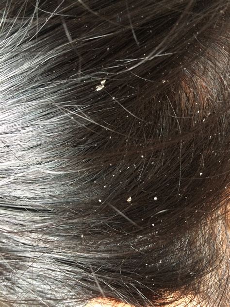 Sodium bicarbonate changes the ph level of the scalp and eliminates the fungi that cause the dreaded dandruff. Home remedies and treatment of Dandruff.