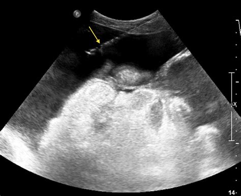 Ascites With Drainage Radiology At St Vincents University Hospital