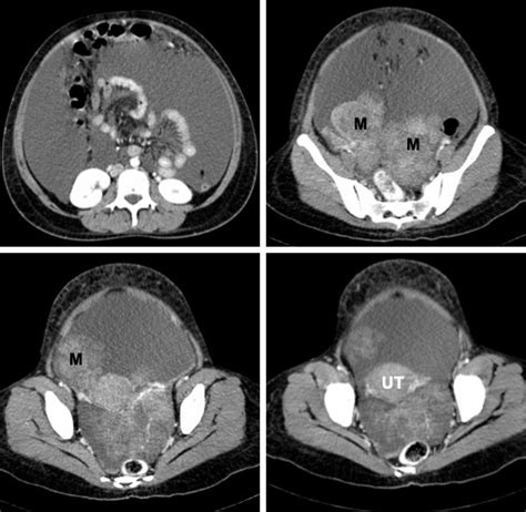 Bilateral Ovarian Serous Cystadenocarcinoma Radiology Cases