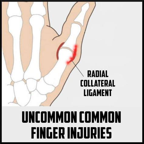 The Uncommon Common Finger Injuries Sports Medicine Review
