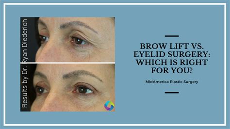 Brow Lift Vs Eyelid Surgery Which Is Right For You