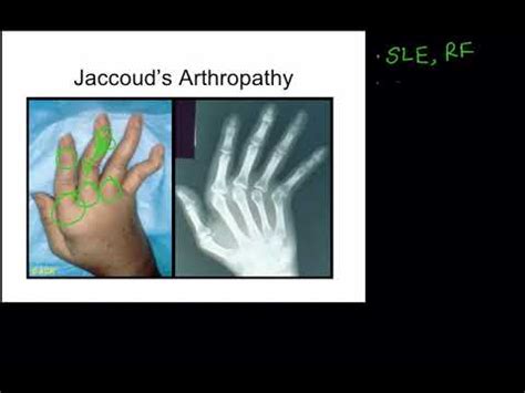 Clinical Features Of SLE Jaccoud S Arthropathy YouTube