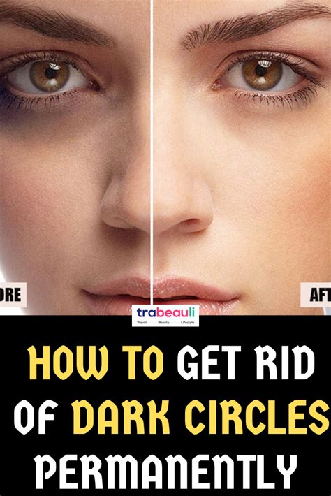 How To Get Rid Of Dark Circles At Home Overnight Trabeauli In 2021