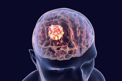 10 Common Brain Diseases Facty Health