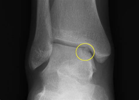 Ocd Lesions Of Talus Yakima Foot And Ankle