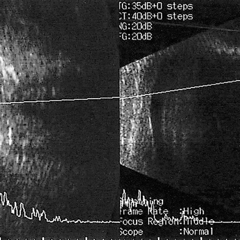 B Scan Ultrasound In Case 1 Showed Thickened Eyeball And Choroidal
