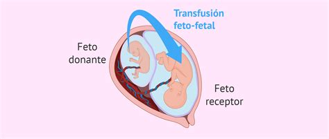 Sindrome De Transfusão Feto Fetal