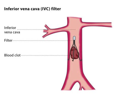 Pin On Interrupted Inferior Vena Cava Ivc
