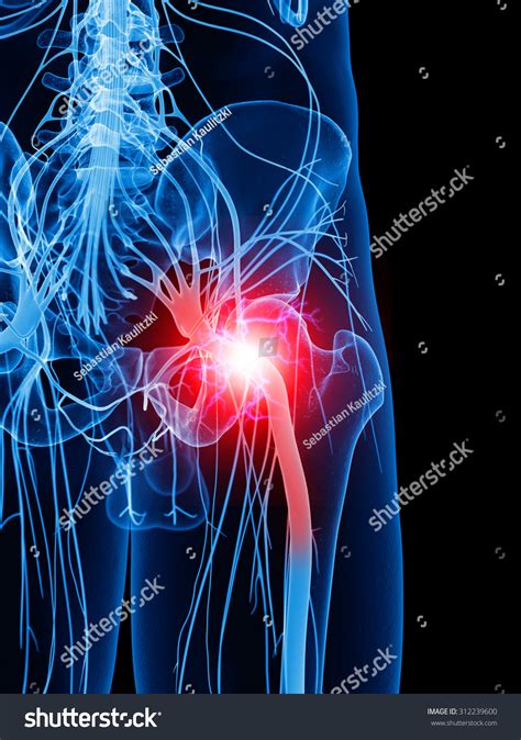Medically Accurate Illustration Painful Sciatic Nerve Stock