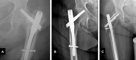 Failure Of Fixation In Trochanteric Hip Fractures Does Nail