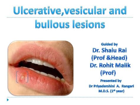 Priya Seminar On Ulcerativevesicular And Bullous Lesions