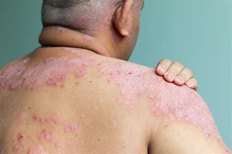 What Is Psoriasis And How Do I Know If I Have It Get Healthy Stay