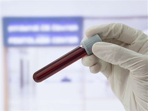 Hematocrit Test Uses Procedure And Results