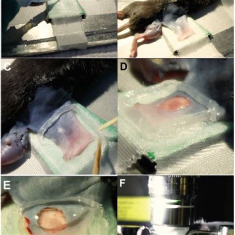 Endoscopic Subcutaneous Modified Inguinal Lymph Node Dissection For Images