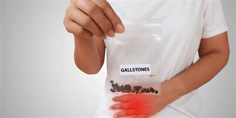 Doctors Explain Causes Symptoms Of Gallstones And How To Fix Them