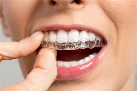 Clear Braces West Mississauga Dental