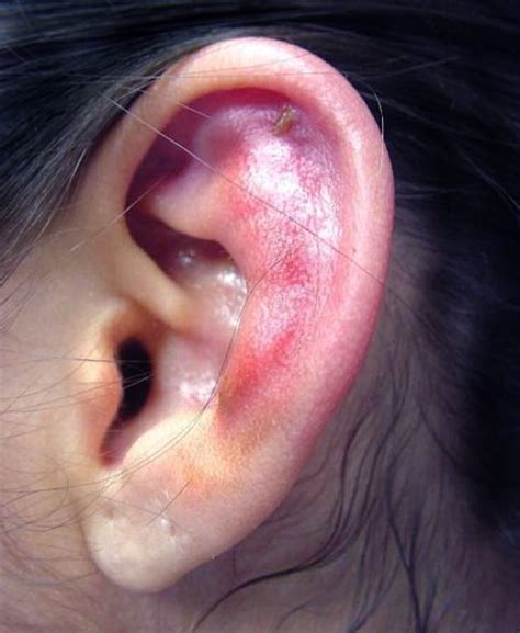 Infected Ear Piercings Causes And Treatment Churinga Ear Piercings Churinga