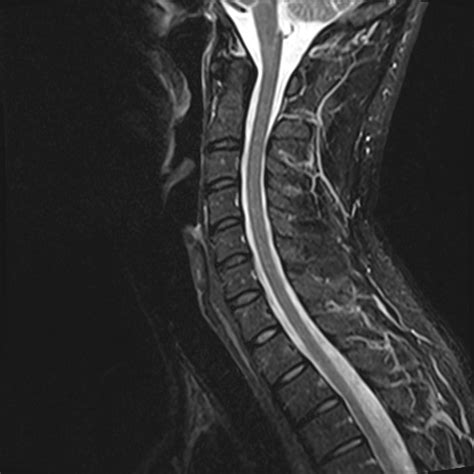 Normal Cervical Spine Mri Image