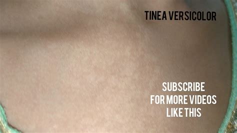 Tinea Versicolor On Chest A Contagious Fungal Infection On Chest Youtube