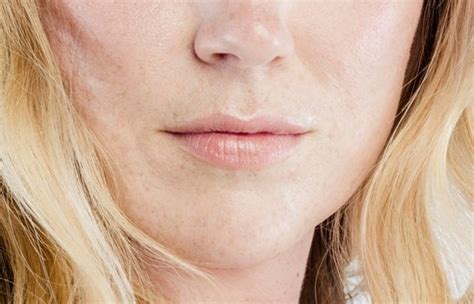 Juvéderm Filler Everything You Need To Know Realself