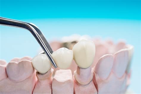 Preguntas frecuentes sobre puentes dentales Clínicas Dentalbell