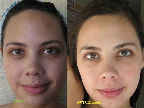 Pin On Before And After Retin A Tretinoin