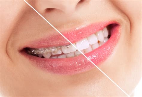 Ceramic Braces Vs Invisalign For Better Or For Worse Knowledge For