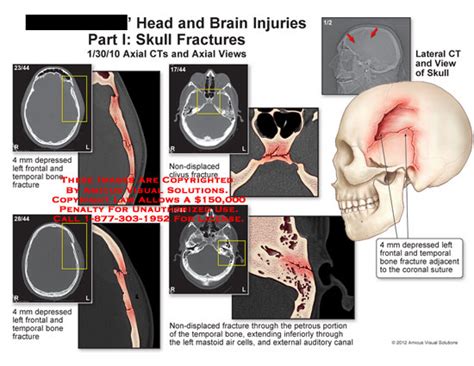 Head And Brain Injuries As Related To Bone Fracture Pictures
