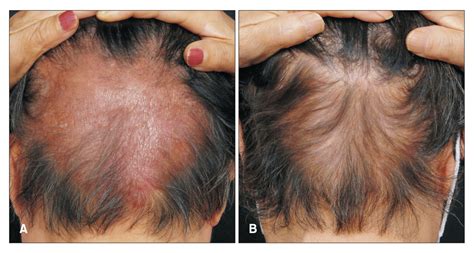 Isolated Scalp Sarcoidosis Causing Hair Loss — Donovan Hair Clinic