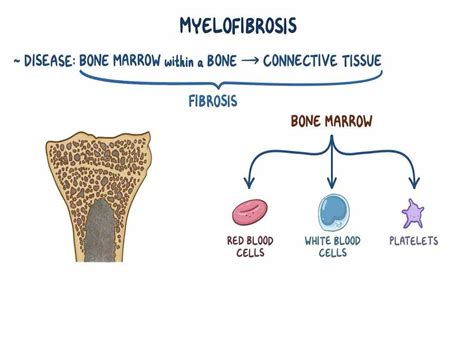Myelofibrosis Treatment A Bone Marrow Transplant Is The Only Potential