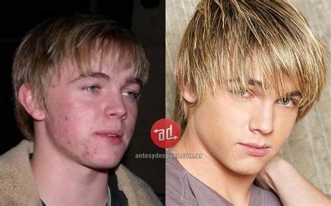 Celebrities With Acne Before And After Photos