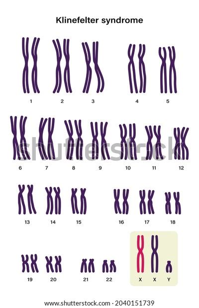 Human Karyotype Klinefelter Syndrome Klinefelters Ks Stock Vector Royalty Free