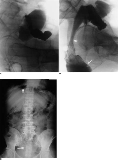 Figure 1delayed Colon Perforation After Palliative Treatment For
