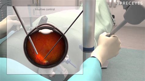 Worlds First Robot Assisted Surgery Inside A Human Eye Saves Sight