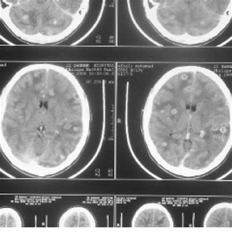 Brain Ct Scan Demonstrates Multiple Hypodense Lesions With Surrounding