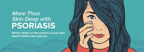 More Than Skin Deep With Psoriasis