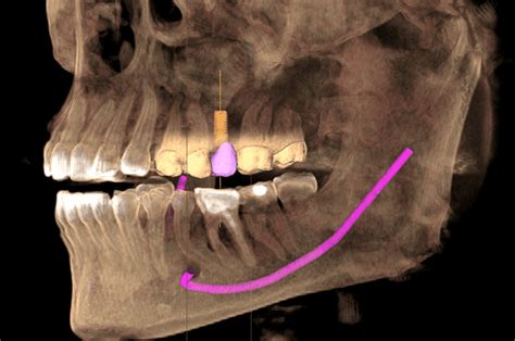 CBCT Imaging Los Angeles CA Digital Denture Implants