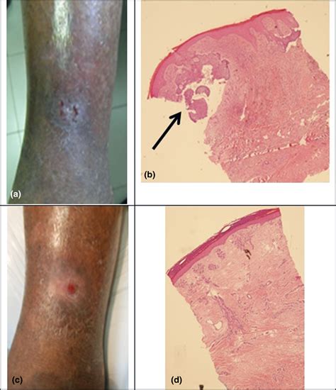 Patient 3 A Suspected Ulcerated Basal Cell Carcinoma Bcc On The