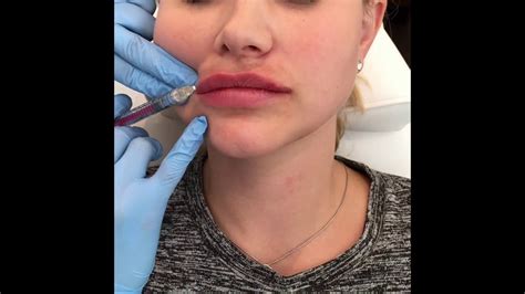 Juvederm Volbella Lip Filler Enhancment With Before And After Photos