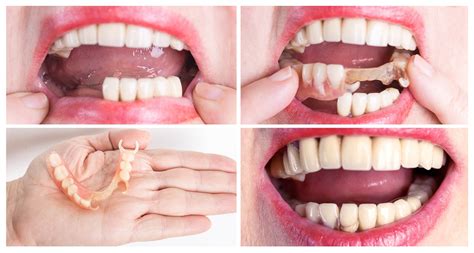 Dentures False Teeth Sandown Dental Practice Isle Of Wight