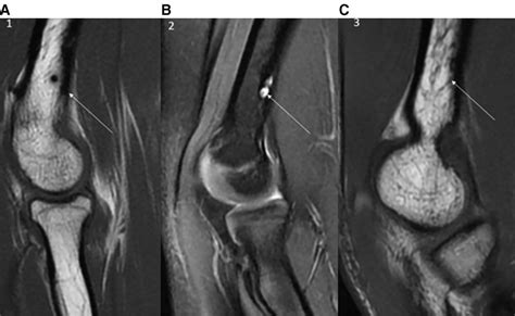 Mri Scans After Fixation With Plga Pins 4 Mo After Surgery The 2 Download Scientific Diagram