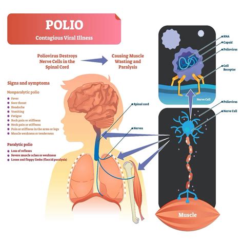 Sindrome Pos Polio Sintomas