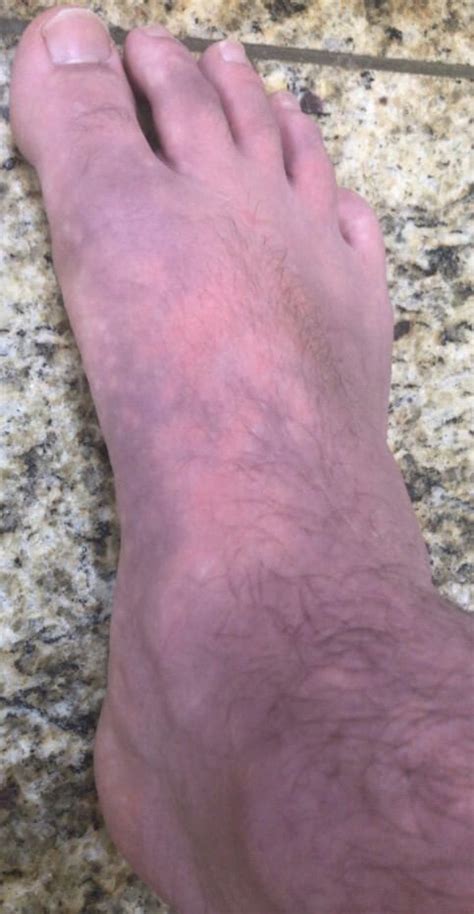 Appearance Of Erythromelalgia In The Left Foot Figure 3 Appearance Of