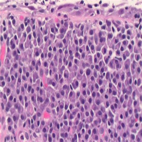 Cureus A Case Of Mucosa Associated Lymphoid Tissue Lymphoma Of The