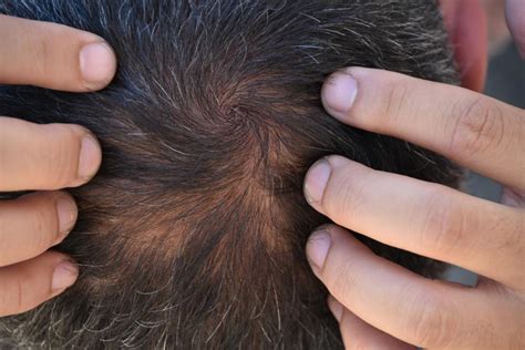 Thinning hair can be distressing to experience, especially when you don't know what's causing it. O eflúvio telógeno é reversível? - PtMedBook